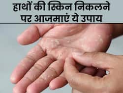 सर्दियों में पपड़ी की तरह निकलने लगी है हाथ की स्किन? इन 5 तरीकों से पाएं इससे छुटकारा
