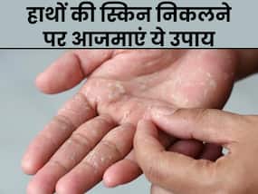 सर्दियों में पपड़ी की तरह निकलने लगी है हाथ की स्किन? इन 5 तरीकों से पाएं इससे छुटकारा