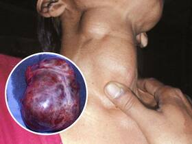 From Bulging Neck to Barely a Trace: 50-Year-Old Nurse Says Goodbye to Multinodular Goitre with Successful Treatment From Bulging Neck to Barely a Trace: 50-Year-Old Nurse Says Goodbye to Multinodular Goitre with Successful Treatment