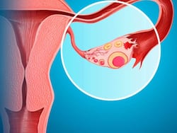 Ovarian Cyst: 7 Early Symptoms of Cyst In Uterus You Should Never Ignore