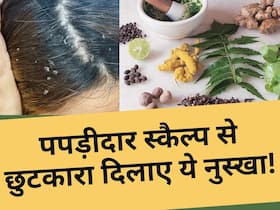इस 1 मात्र नुस्खे से सर्दियों में पपड़ीदार स्कैल्प से पाएं छुटकारा, घंटे भर में दिखेगा असर