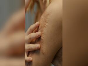 Nature's Healing Touch for Minor Skin Burns