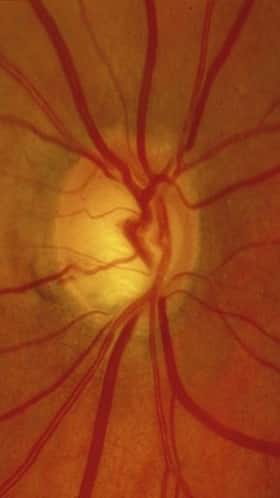 Losing Your Peripheral Vision? 8 Shocking Causes You Can't Ignore