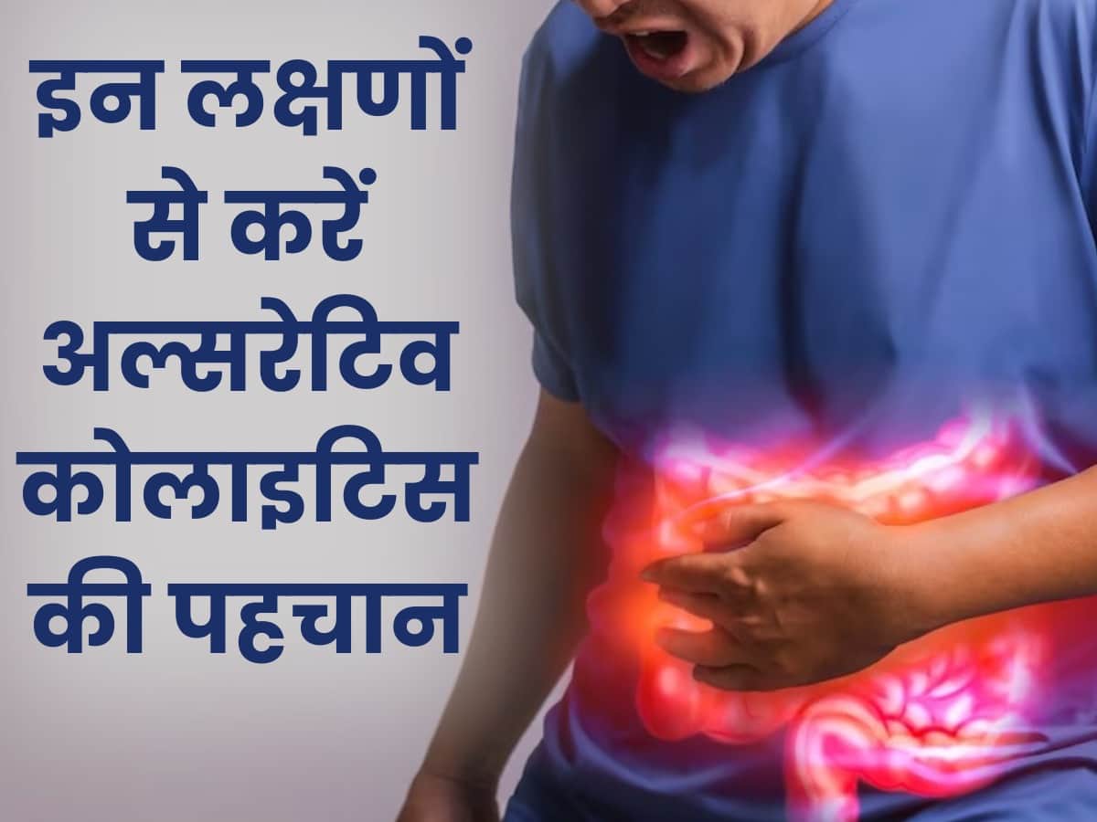 अल्सरेटिव कोलाइटिस क्या है? जानें इसके लक्षण, कारण और बचाव के उपाय