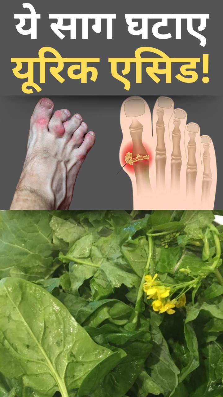 इन 7 तरह के साग से घटाएं यूरिक एसिड