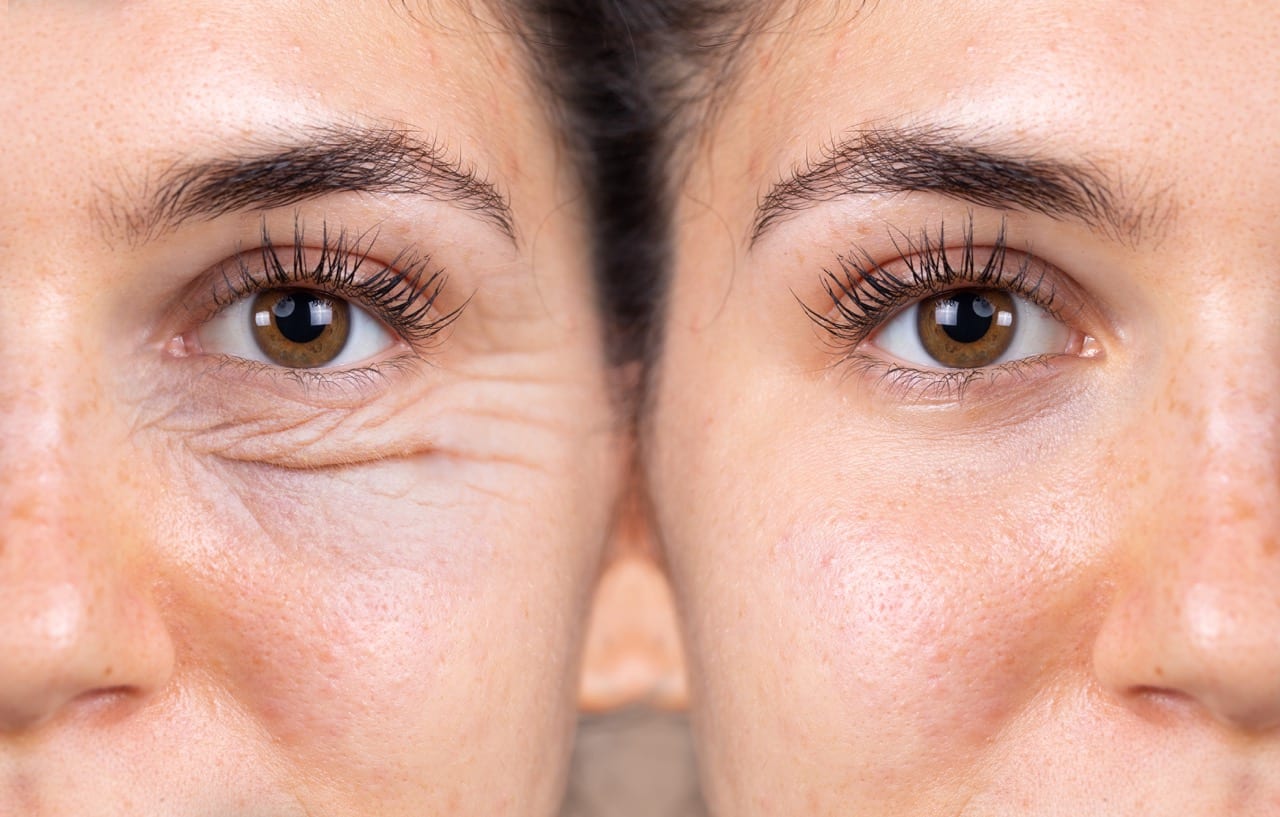 Blepharoplasty: All About The Most Common Cosmetic Surgery Procedure - Vimarsana News