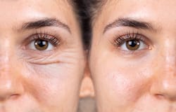 Blepharoplasty: All About The Most Common Cosmetic Surgery Procedure