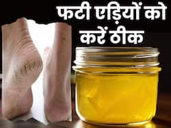 रसोई में छिपा है फटी एड़ियों को ठीक करने का रामबाण इलाज, हफ्ते भर में दिखेगा असर