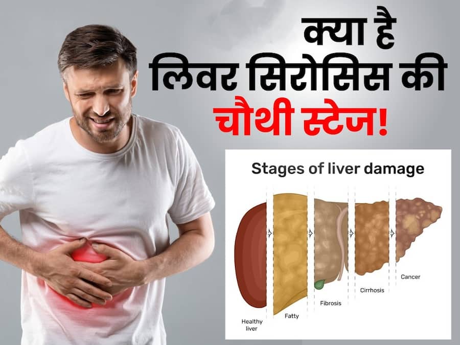 कितनी खतरनाक हो सकती है लिवर सिरोसिस की चौथी स्टेज? लक्षणों को इग्नोर करना हो सकता है जानलेवा