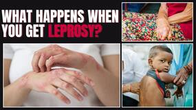Leprosy: Symptoms, Types, and Who's at Risk! Everything You Need to Know