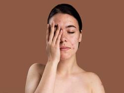 Skin Health: Your Ultimate Guide For Combating All Your Acne Scars