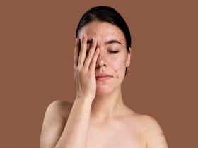 Skin Health: Your Ultimate Guide For Combating All Your Acne Scars