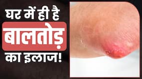 Baltod Remedies: बालतोड़ का इलाज करेंगे घर में रखीं ये चीजें, देखें ये Video
