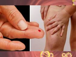 Diabetes Symptoms In Women: 7 Warning Signs of High Blood Sugar That Appears At Night On Legs and Feet