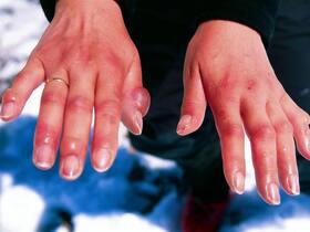 FDA Approves First Treatment For Frostbite: Know All About It