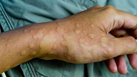 Psychodermatology: All About Stress-Induced Skin Reaction Psychodermatology: All About Stress-Induced Skin Reaction