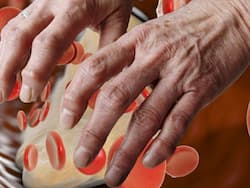 High Cholesterol Symptoms In Women: 5 Unusual Signs of High LDL Levels On Fingers