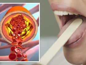 High Cholesterol Symptoms In 30s Women: 7 Unusual Signs of High Bad LDL Cholesterol Levels On Tongue