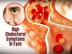 High Cholesterol Symptoms In Men: 5 Unusual Signs of High Bad LDL Cholesterol Levels In Eyes
