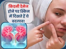किडनी डैमेज होने से पहले स्किन पर दिखते हैं ये 5 लक्षण, इग्नोर करना पड़ सकता है भारी