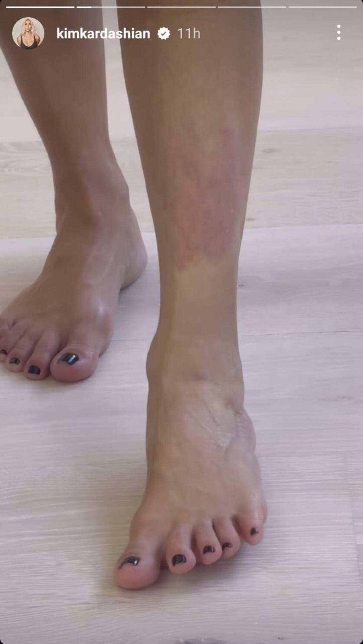 Kim Kardashian Gives An Update About 'Painful' Psoriasis Flareup  | TheHealthSite.com