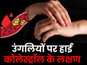 कोलेस्ट्रॉल जब बढ़ जाए हद से ज्यादा तो हाथों-पैरों और उंगलियों पर दिखते हैं ये लक्षण, इग्नोर करना पड़ सकता है महंगा