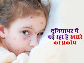 दुनियाभर में बढ़े खसरा के मामले कई गुना, इस उम्र के बच्चों को है इस बीमारी का सबसे ज्यादा रिस्क