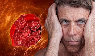 High Cholesterol Symptoms On Face: 7 Warning Signs of Excessive Bad Cholesterol That May Show Up On Your Skin