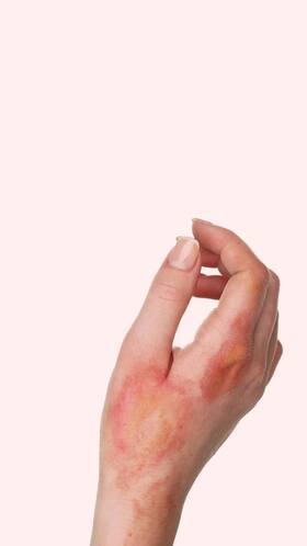 स्किन के जल जाने पर बर्फ लगाना सही या नही? जानिए यहां