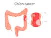4 Tips That Can Reduce The Risk Of Developing Colon Cancer