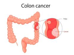 4 Tips That Can Reduce The Risk Of Developing Colon Cancer