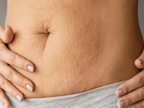 Post-Pregnancy Cellulite Removal: Exclusive From Shahnaz Husain
