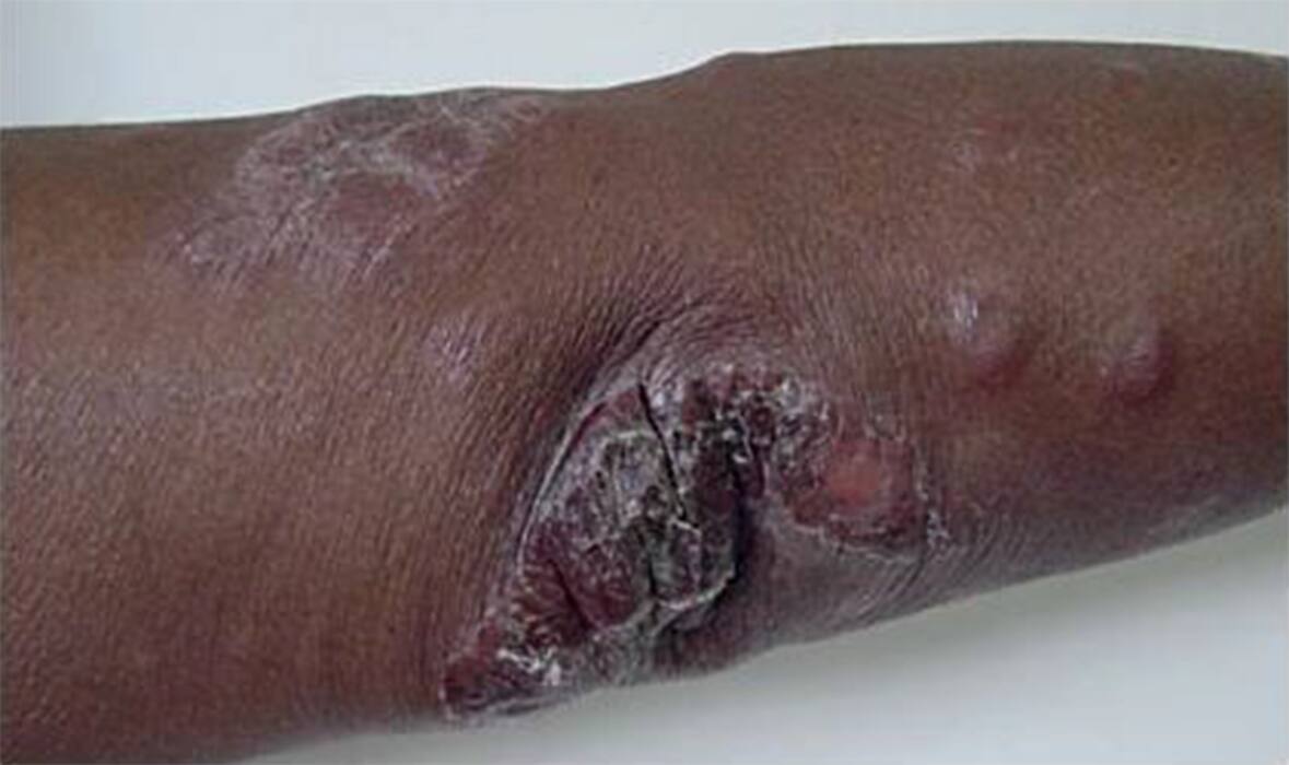 Hansen's Disease: Impact Of Leprosy On Pregnant Women And Their Unborn Children