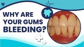 Bleeding Gums: Why Do Gums Bleed? Causes You Should Know