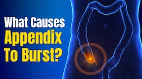Appendicitis: What are the signs, causes, and how to treat it? | Acute Appendicitis | The Healthsite Appendicitis: What are the signs, causes, and how to treat it? | Acute Appendicitis | The Healthsite