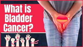 Bladder Cancer: What are the causes of this cancer? How do you reduce the risk of bladder cancer? Bladder Cancer: What are the causes of this cancer? How do you reduce the risk of bladder cancer?