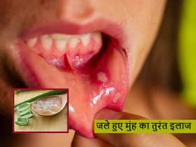 Burn Mouth Remedy: गर्म चीज खाने के कारण जल गई है जीभ? तो 3 आसान से घरेलू नुस्खों से तुरंत मिलेगा आराम