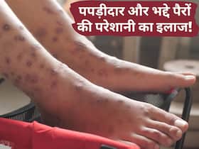 पपड़ीदार और भद्दे पैर होने के पीछे हो सकती है ये वजह, घर पर इन तरीकों से करें इसका इलाज