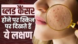 Blood Cancer Face Symptoms: चेहरे पर दिखने लगे ये लक्षण तो हो जाएंगे Alert!