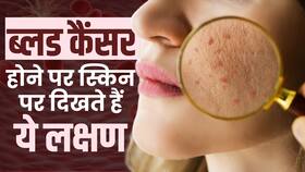 Blood Cancer Face Symptoms: चेहरे पर दिखने लगे ये लक्षण तो हो जाएंगे Alert!