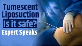 How safe is tumescent liposuction? Expert Speaks
