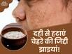 जिद्दी झाइयां हटाने के लिए दही में मिलाकर लगा लें ये 3 चीजें, शीशे की तरह चमक जाएगा चेहरा