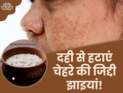 जिद्दी झाइयां हटाने के लिए दही में मिलाकर लगा लें ये 3 चीजें, शीशे की तरह चमक जाएगा चेहरा
