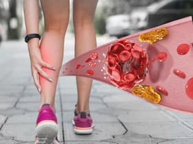What Causes Varicose Veins? Does It Only Affect Elderly People? Know From A Doctor