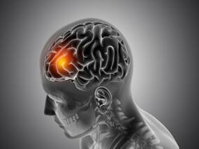 When Chronic Migraine Pain Turned Out To Be Worm Eggs In Florida Man's Brain