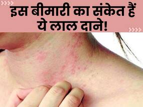 स्किन पर दिख रहे लाल चकत्ते और दाने हो सकते हैं इस बीमारी का हैं संकेत, इग्नोर करने की न करें गलती