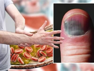 High Cholesterol Symptoms In Men: 7 Warning Signs of High Bad LDL Cholesterol Levels On Nails And Fingers