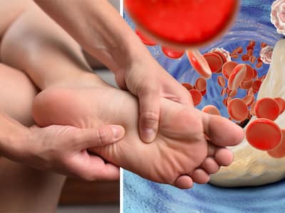 High Cholesterol Symptoms In Women: 5 Unusual Signs of High Bad LDL Cholesterol Levels In Legs And Feet