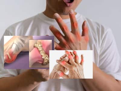 High Uric Acid Symptoms In Men Management Tips: Top 7 Ayurvedic Drinks