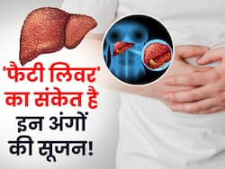फैटी लिवर का संकेत है शरीर के इन अंगों में आई सूजन, नजर अंदाज करने से Liver Damage की आ जाएगी नौवत